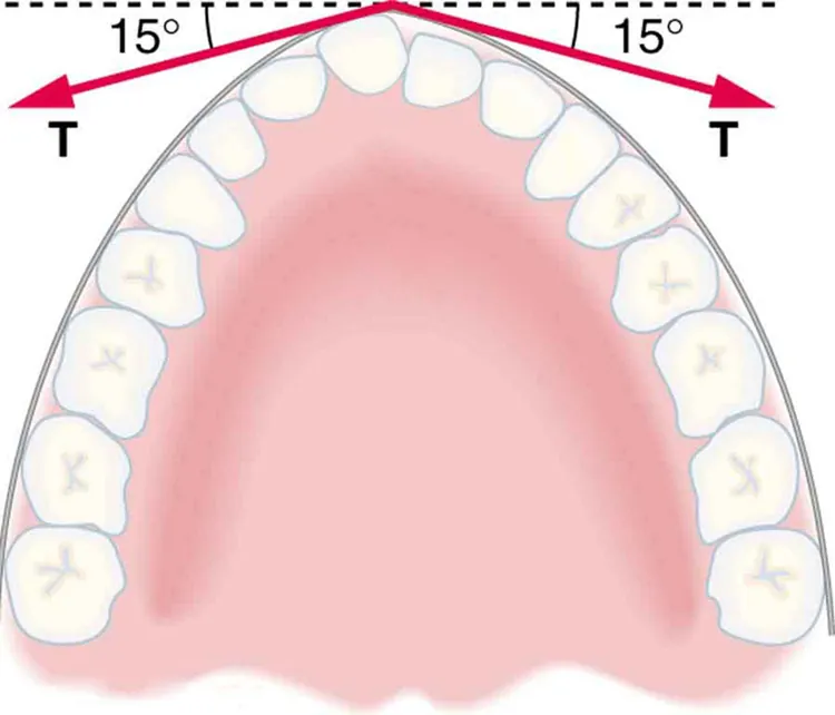 Cross-section of jaw with sixteen teeth is shown. Braces are along the outside of the teeth. Three forces are acting on the protruding tooth. A force, T, is shown by an arrow making an angle of fifteen degrees below the positive x axis, and a second force, T, is shown by an arrow making an angle of fifteen degrees below the negative x axis.