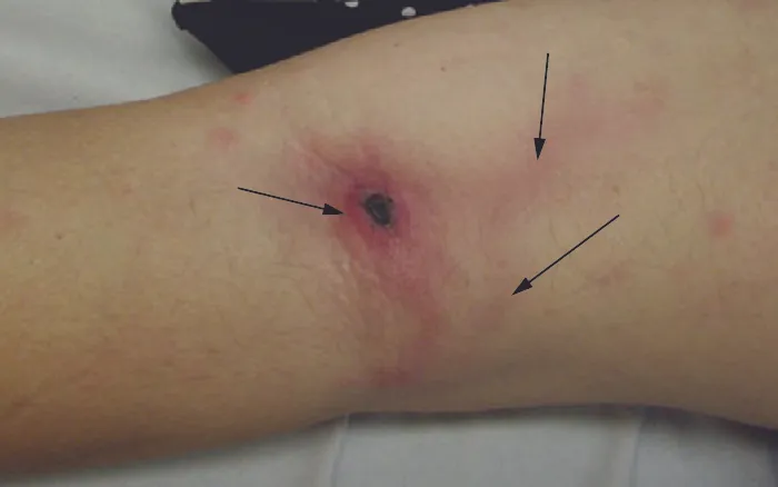 An arm with a dark red spot on the elbow with red lines emanating from it under the skin.