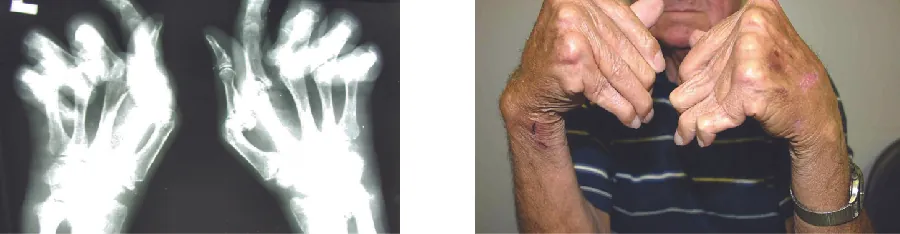 X-ray and photo of hands with joints bent at unusual angles.