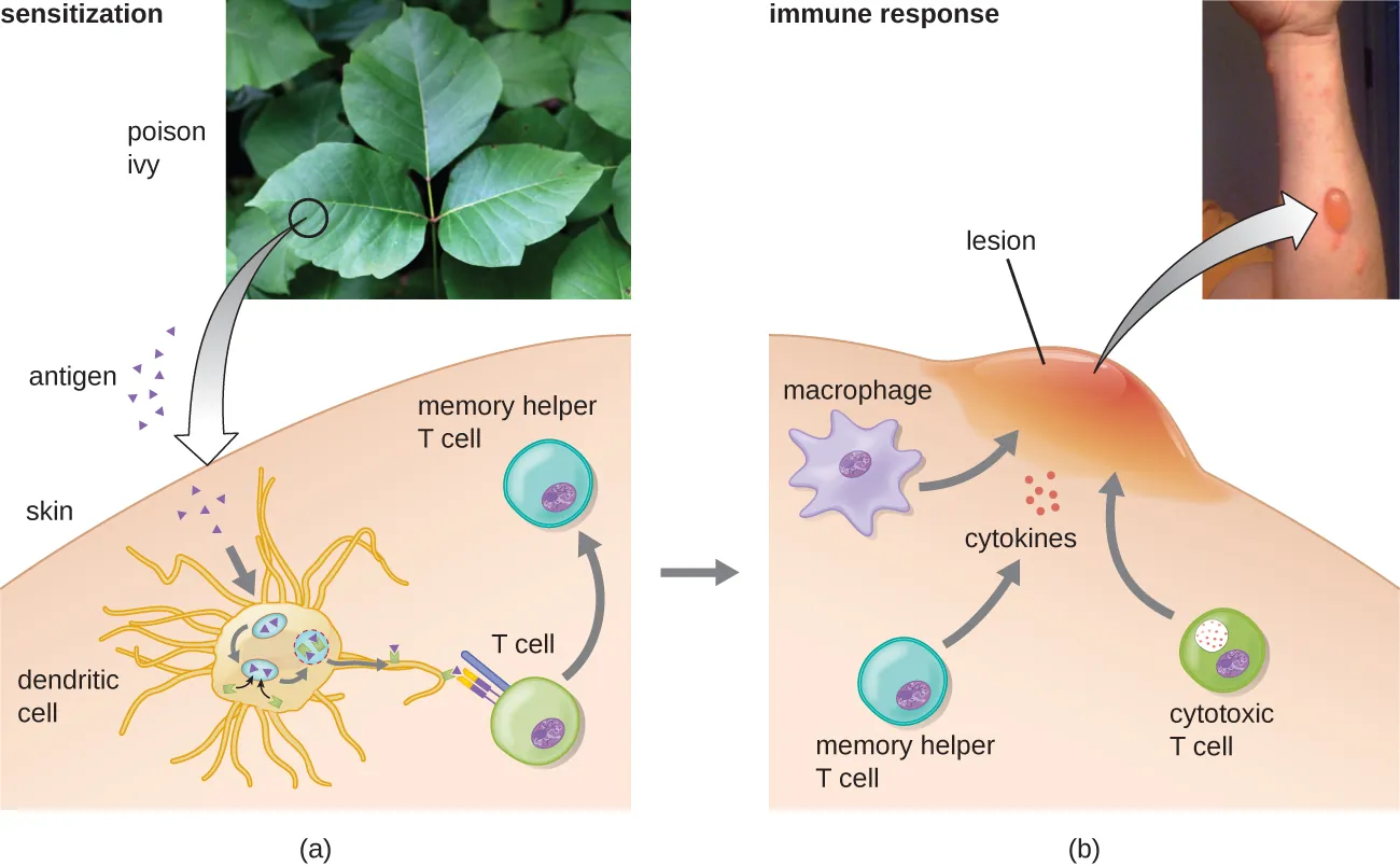 a) Sensitization. Antigens from poison ivy enter dendritic cells in skin. The dendritic cell activates a T-cell which becomes a memory helper T cell. b) Immune response. Macrophages, memory helper T cells, and cytotoxic T cells produce a large lesion on the skin due to dytikine activation.