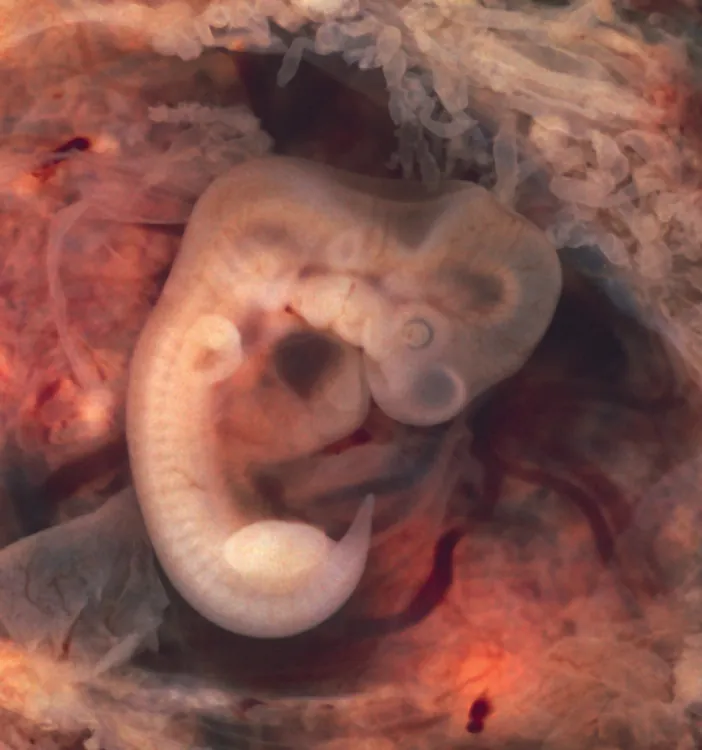 This photograph shows a seven-week embryo which derived from an ectopic pregnancy.