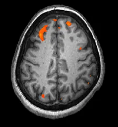 Obraz pokazuje tkankę mózgową w kolorze szarym, ale niektóre, niewielkie obszary świecą na czerwono.