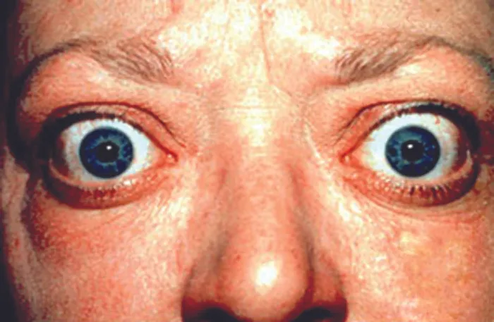 Photo of a person with large bulging eyes.