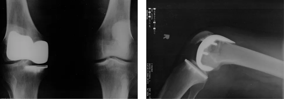 Dos imágenes de rayos X de prótesis de rodilla artificial.