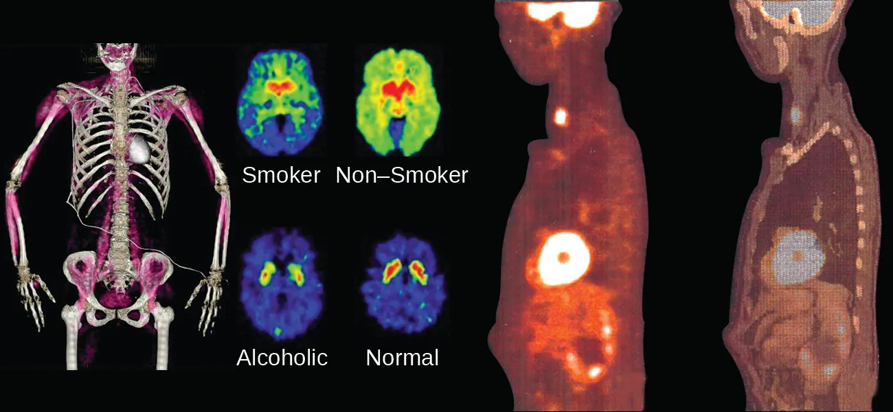 An image shows four sets of medical pictures. The first is the torso and arms of a human skeleton with purple shading in the muscular regions. The second is a set of four images; the top left, labeled “Smoker,” shows an oval-shaped image that is blue on the outside rim, green as you move inward, and bright red near the center while the top right, labeled “Non-Smoker,” shows an oval-shaped image that is shaded bright green over most of the image and bright red near the center. The lower left image of the four, labeled “Alcoholic,” shows an oval-shaped image that is almost entirely blue with two small yellow-rimmed, red dots near the upper middle section while the lower right image, labeled “Normal,” looks very similar to the lower left, but the red regions are slightly larger. The final image show two scans of a human torso that is turned to face to the side. The left scan has three bright yellow-white areas; one in the throat, one in the chest and one in the head. The right scan is the same as the left except the bright regions are dim and the internal organs are more clearly defined.