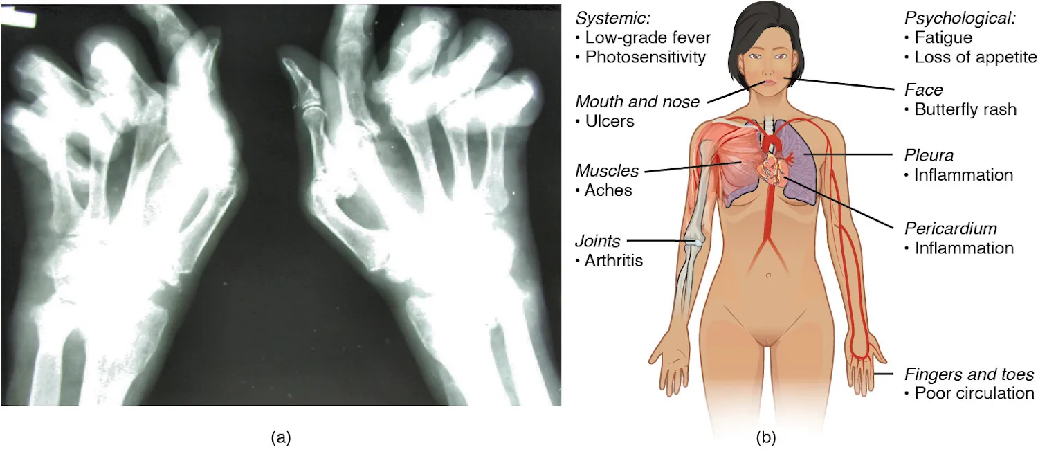 The left panel of this figure shows an x-ray image of a person’s hand with rheumatoid arthritis, and the right panel of this figure shows a woman’s body with labels showing the different responses in the body when the patient suffers from lupus.