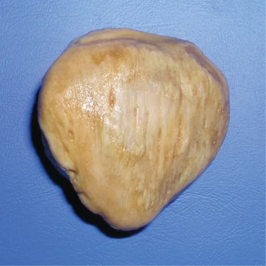 The patella is a flat, teardrop-shaped bone.