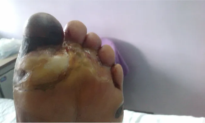 A swollen foot with peeling skin and black regions under the skin.