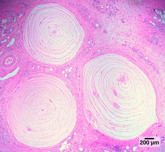 Micrograph shows three Pacinian corpuscles embedded in the dermis. The corpuscles are round and about 1.4 millimeters across and have rings, like a tree stump.