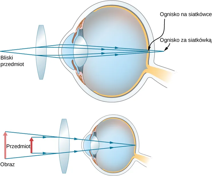 Figura pokazuje dwa schematy oka ludzkiego, przed przednią powierzchnią oka znajduje się soczewka dwuwypukła. Dla pierwszego oka widzimy 2 promienie biegnące od przedmiotu położonego blisko oka, które padają na soczewkę, odchylają się od pierwotnego kierunku biegu, po czym padają na rogówkę. Następnie skupiają się na siatkówce. Drugi rysunek przedstawia przedmiot leżący blisko soczewki, i jego obraz większy niż przedmiot i położony dalej od soczewki niż przedmiot.