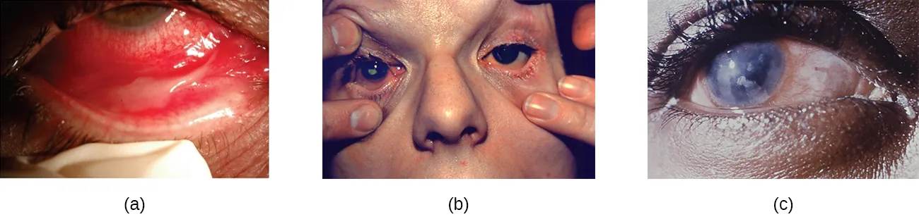 a) photo of an eyelid being pulled back to show a red are. B) A photo of inflamed eyelids. C)A photo of an eye with a cloudy cornea.