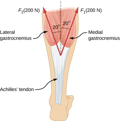 An Achilles tendon is shown in the figure with two forces exerted on it by the lateral and medial heads of the gastrocnemius muscle. F sub one, equal to two hundred Newtons, is shown as a vector making an angle twenty degrees to the right of vertical, and F sub two, equal to two hundred Newtons, is shown making an angle of twenty degrees left of vertical.