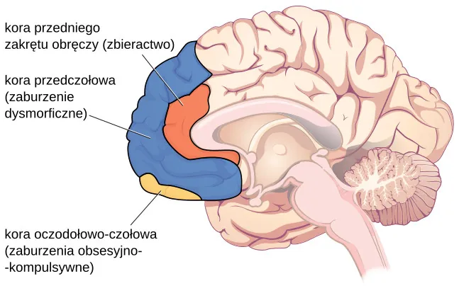 Rysunek mózgu pokazuje trzy obszary specyficznie powiązane z określonymi zaburzeniami: korę przedniego zakrętu obręczy (zbieractwo), korę przedczołową (zaburzenie dysmorficzne) i korę oczodołowo-czołową (zaburzenia obsesyjno-kompulsywne). 