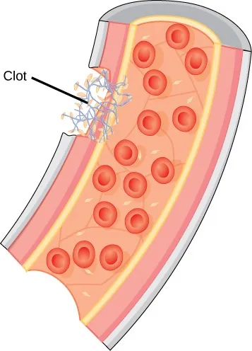 Illustration of a wound site on the wall of a blood vessel with fibrinogen collecting at the site and a pointer labeling the area “clot.”
