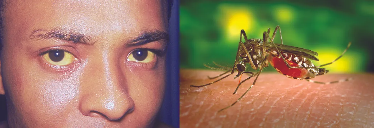 Photo of a person with yellow eyes. Photo of a mosquito on an arm.
