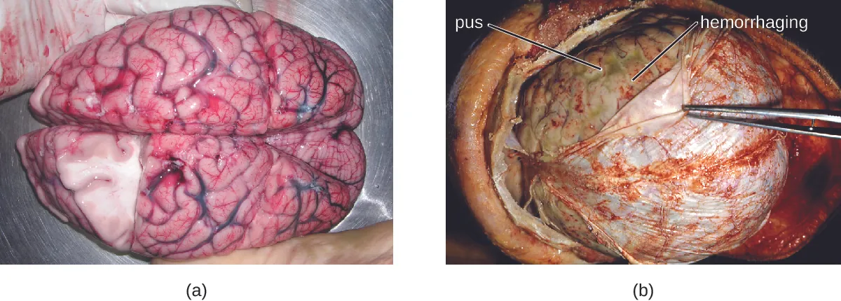 a) Photo of brain. B) Photo of think layer on top of brain being pulled back by forceps.
