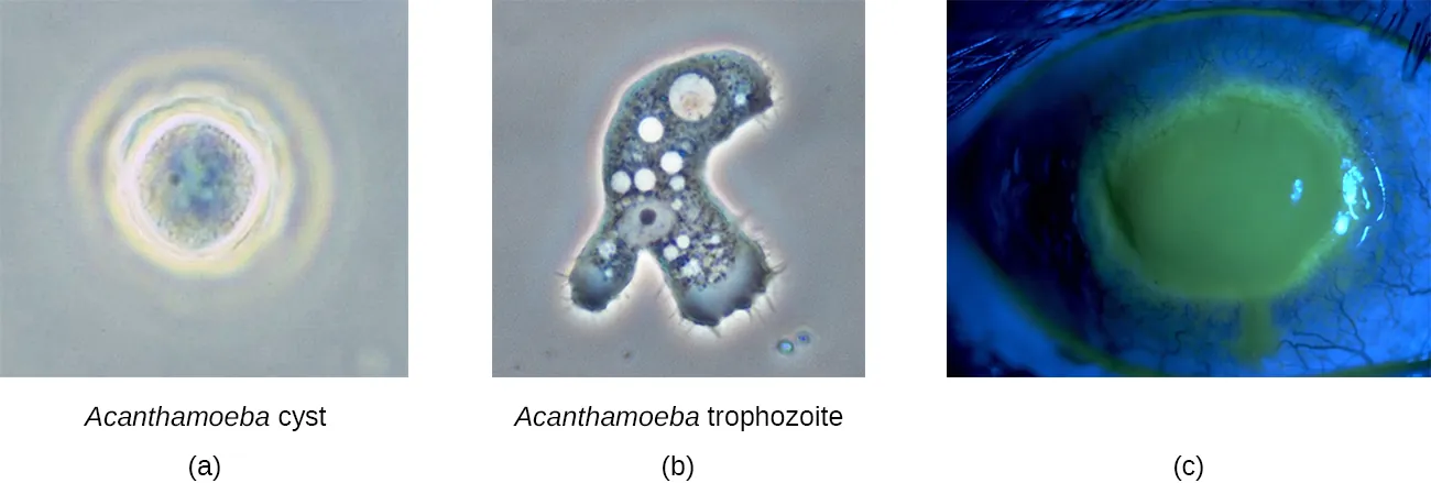 a) an acanthamoeba cyst is shown. b) an acanthamoeba trophozoite micrograph is shown. c) a photo of an eye with a fluorescent cornea is shown.