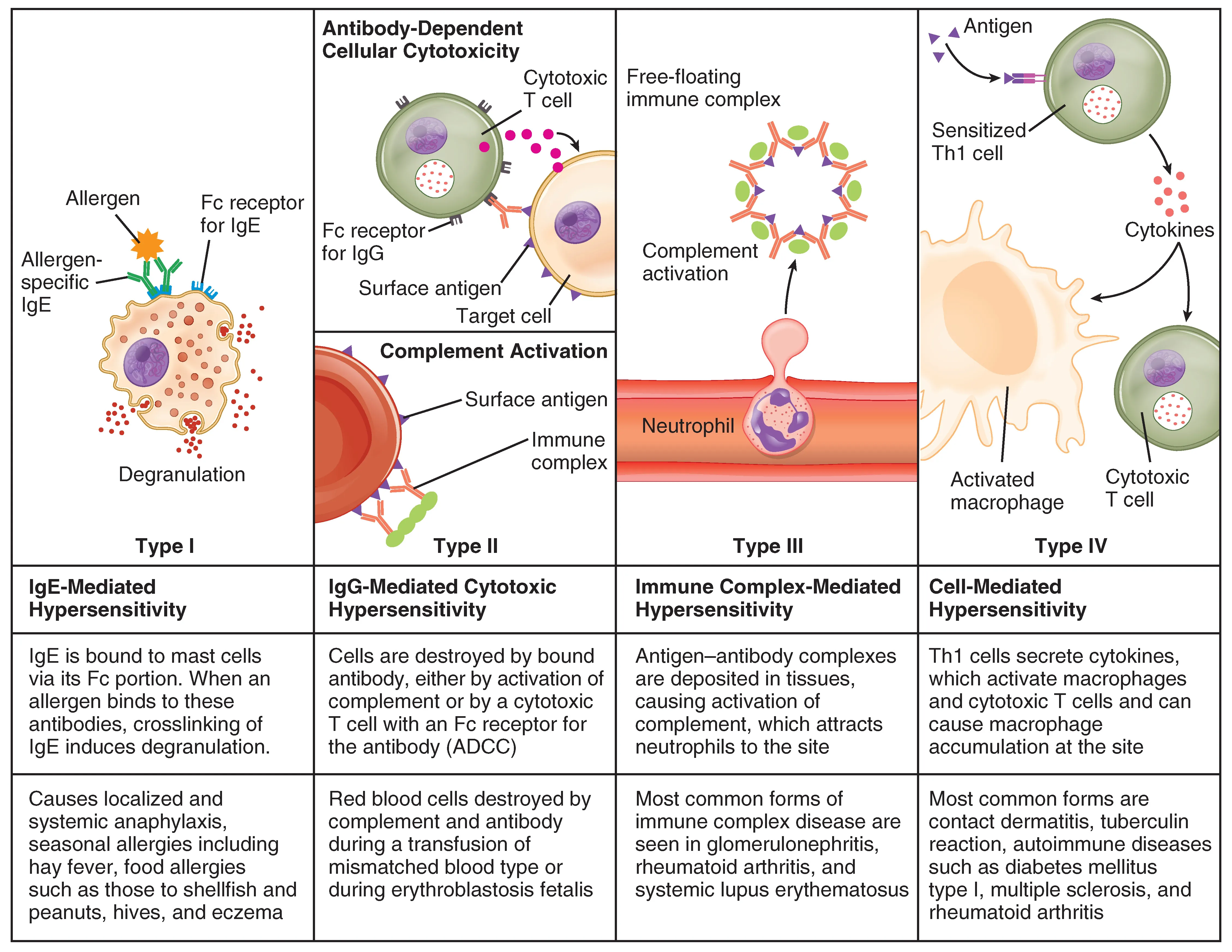 This table describes different types of hypersensitivity. In Type I (IgE-Mediated Hypersensitivity), IgE is bound to mast cells via its Fc portion. When an allergen binds to these antibodies, crosslinking of IgE induces degranulation. Type I causes localized and systemic anaphylaxis, seasonal allergies including hay fever, food allergies such as those to shellfish and peanuts, hives, and eczema. In Type II (IgG-Mediated Hypersensitivity), cells are destroyed by bound antibody, either by activation of complement or by a cytotoxic T cell with an Fc receptor for the antibody (ADCC). Examples are when red blood cells are destroyed by complement and antibody during a transfusion of mismatched blood types or during erythroblastosis fetalis. In Type III (Immune Complex-Mediated Hypersensitivity), antigen-antibody complexes are deposited in tissues, causing activation of complement, which attracts neutrophils to the site. Most common forms of immune complex disease are seen in glomerulonephritis, rheumatoid arthritis, and systemic lupus erythematosus. In Type IV (Cell-Mediated Hypersensitivity), Th1 cells secrete cytokines, which activate macrophages and cytotoxic T cells and can cause macrophage accumulation at the site. Most common forms are contact dermatitis, tuberculin reaction, and autoimmune diseases such as diabetes mellitus type I, multiple sclerosis, and rheumatoid arthritis.