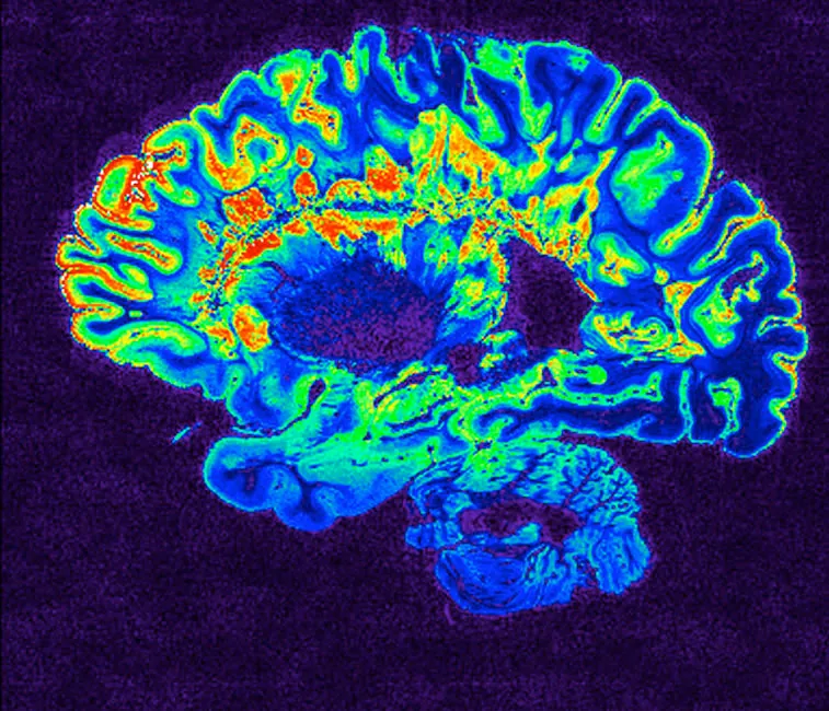An M R I image shows the active nodes in the brain.