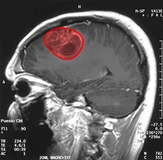 Imagen de resonancia magnética del cerebro de un paciente con un tumor resaltado en rojo.
