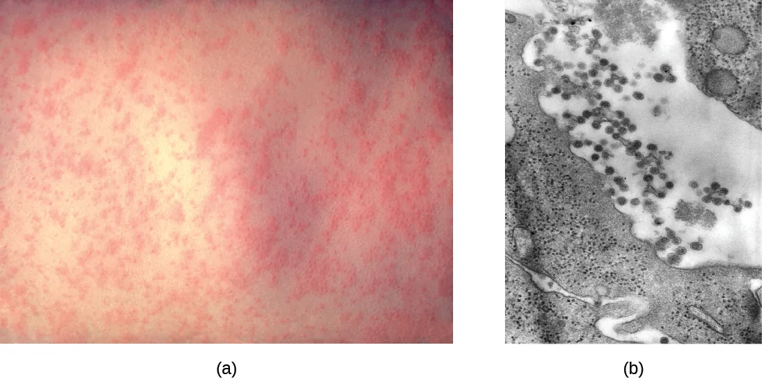 a) red bumps on a person's back. b) a micrograph of rubella.