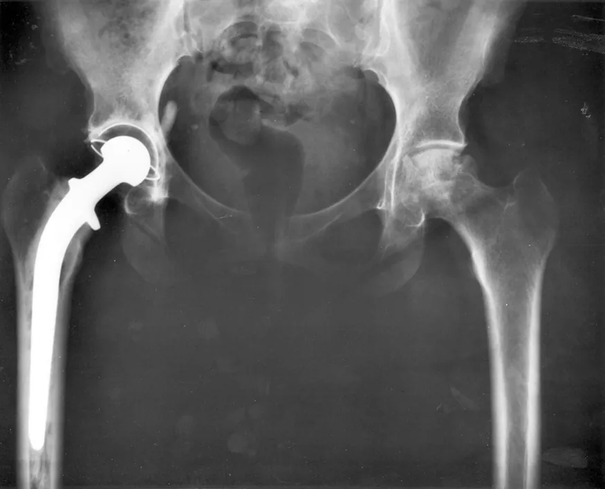 An x-ray image of a person's hips. The right hip joint (on the left in the photograph) has been replaced. A metal prosthesis is cemented in the top of the right femur and the head of the femur has been replaced by the rounded head of the prosthesis. A white plastic cup is cemented into the acetabulum to complete the two surfaces of the artificial ball and socket joint.