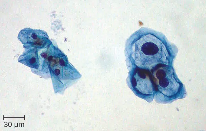 Micrograph of cells. On the left are thin flaky cells with nuclei. On the right are cells with much larger nuclei.