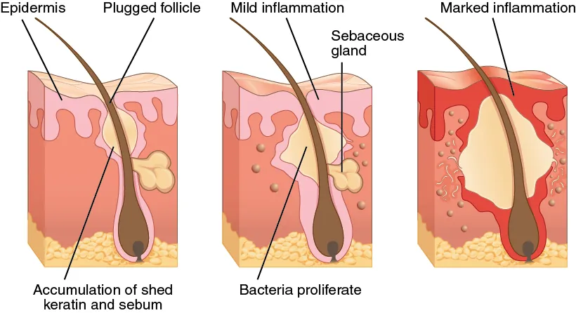 Three diagrams show the progression of acne in three steps from left to right. All three depict a cross section of skin containing a hair follicle. In the left diagram, the follicle has a swollen area about halfway up the hair shaft, just above a sebaceous gland. The follicle is plugged with sebum, depicted as a yellowish substance. In the middle diagram, the follicle has become more swollen, as a label indicates that bacteria are reproducing within the blockage. The surrounding epidermis becomes inflamed as a result of the bacterial infection. In the rightmost image, the blockage has swollen to about five times its original size and has broken the surrounding epidermis, which is now red and inflamed.