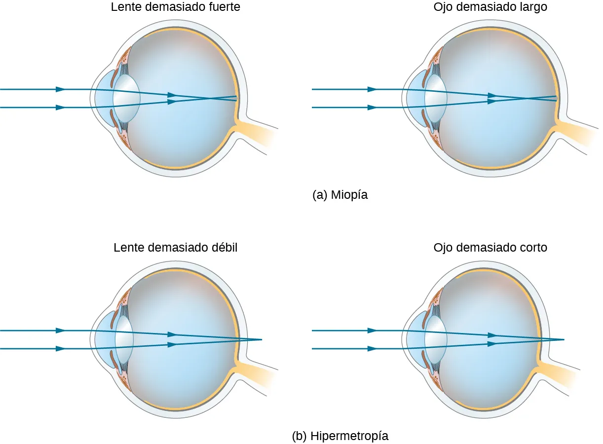 La figura a muestra dos ojos marcados como “cristalino demasiado fuerte" y "ojo demasiado largo". En ambos casos, los rayos paralelos que inciden en la córnea convergen delante de la retina. La figura b muestra dos ojos etiquetados como “cristalino demasiado débil" y "ojo demasiado corto". En ambos casos, los rayos paralelos que inciden en la córnea convergen detrás de la retina.