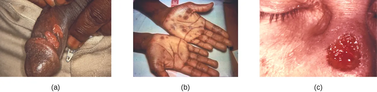 a) Photo of red, open sores on a penis. B) Photo of brown spots on the palm of the hands. C) Photo of a red, open sore on the nose.