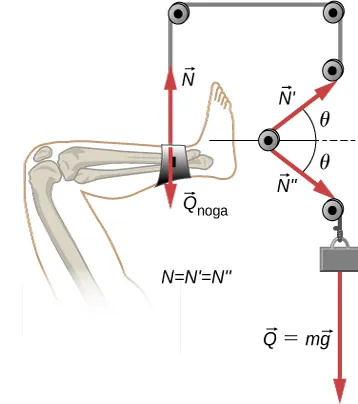 Rysunek pokazuje nogę przymocowaną do szpitalnego układu unieruchamiającego. Układ składa się z obciążenia o ciężarze w skierowanym w dół oraz z linki przerzuconej przez kołowroty, w której to siła naciągu przy punkcie umocowania nogi wynosi T. Skierowana jest w górę.