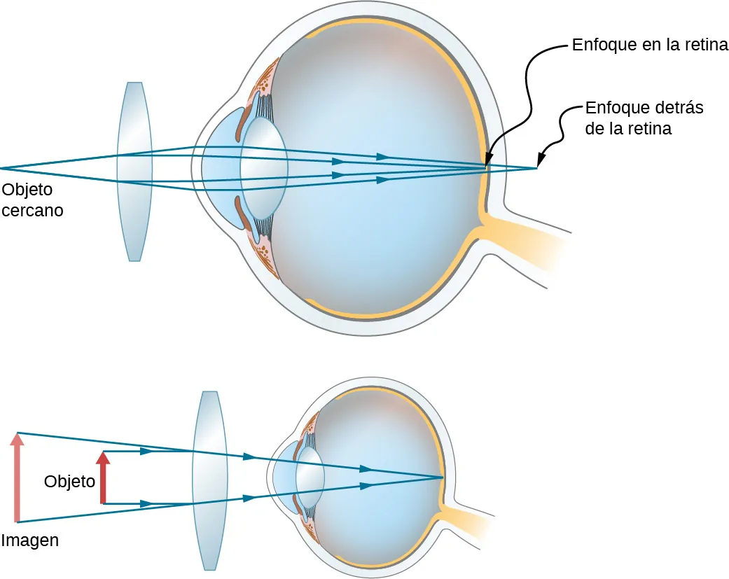 La figura muestra dos ojos con una lente biconvexa delante de cada uno. La primera muestra los rayos procedentes de un objeto cercano que inciden en el cristalino y se desvían entre sí antes de incidir en la córnea. Luego convergen en la retina. La segunda muestra un objeto cercano al objetivo y una imagen vertical, más grande, más alejada del objetivo.