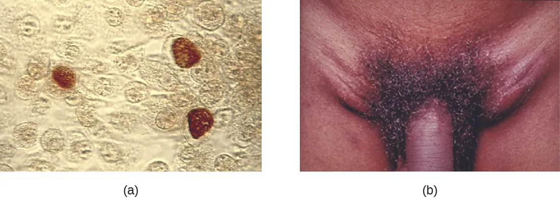 a) Micrograph showing brown coloration inside cells. B) photo of a swollen region on either side of the penis.