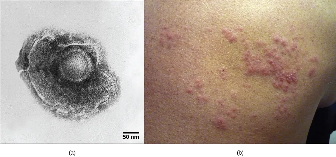 Part a shows a micrograph of the varicella-zoster virus, which has an icosahedral capsid surrounded by an irregularly shaped envelope. Part b shows a red, bumpy shingles rash on a person’s face.