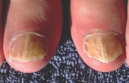 A color photograph showing tinea unguium