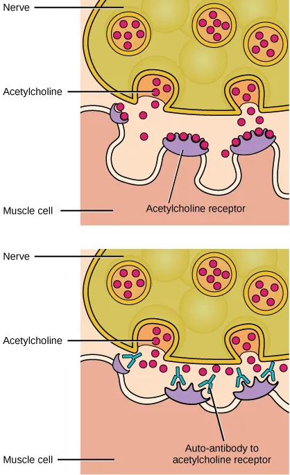 A pair of figures show the release of acetylcholine from a nerve cell to bind with acetylcholine receptors of a muscle cell and a similar illustration in which auto-antibodies to acetylcholine receptors prevent acetylcholine from binding. The upper illustration shows the lower left of an oval structure labeled nerve that contains three intact circles each containing five to six small circles. There are two similar circles that have fused with the bottom membrane of the nerve cell to begin to release the small circles within, labeled acetylcholine, into a gap below. Beneath the gap, there is the folded upper membrane of a muscle cell. The muscle cell has three protrusions into the gap with invaginations between them. The top of each protrusion has an oval structure with circular cutouts on top. These oval structures are labeled acetylcholine receptors. The oval structure at the upper left is small with cutouts containing two molecules of acetylcholine and the ovals above center and right-hand protrusions are larger and are each bound to four acetylcholine molecules. Seven acetylcholine molecules are loose within the gap. The bottom illustration is similar except that there are five “Y”-shaped auto-antibodies to acetylcholine receptors within the gap preventing acetylcholine from binding. The left-hand acetylcholine receptor forms a crescent with the fork of an auto-antibody above it. The center and right-hand acetylcholine receptors each have two auto-antibodies above them with the auto-antibody forks enclosing protrusions and extending to fill four of the cutouts into which acetylcholine would otherwise bind.