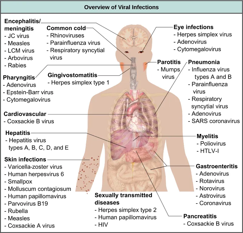 The illustration shows an overview of human viral diseases. Viruses that cause encephalitis or meningitis, or inflammation of the brain and surrounding tissues, include measles, arbovirus, rabies, JC virus, and LCM virus. The common cold is caused by rhinovirus, parainfluenza virus, and respiratory syncytial virus. Eye infections are caused by herpes simplex virus, adenovirus, and cytomegalovirus. Pharyngitis, or inflammation of the pharynx, is caused by adenovirus, Epstein-Barr virus, and cytomegalovirus. Parotitis, or inflammation of the parotid glands, is caused by mumps virus. Gingivostomatitis, or inflammation of the oral mucosa, is caused by herpes simplex type I virus. Pneumonia is caused by influenza virus types A and B, parainfluenza virus, respiratory syncytial virus, adenovirus, and SARS coronavirus. Cardiovascular problems are caused by coxsackie B virus. Hepatitis is caused by hepatitis virus types A, B, C, D, and E. Myelitis is caused by poliovirus and HLTV-1. Skin infections are caused by varicella-zoster virus, human herpesvirus 6, smallpox, molluscum contagiosum, human papillomavirus, parvovirus B19, rubella, measles, and coxsackie A virus. Gastroenteritis, or digestive disease, is caused by adenovirus, rotavirus, norovirus, astrovirus, and coronavirus. Sexually transmitted diseases are caused by herpes simplex type 2, human papillomavirus, and HIV. Pancreatitis is caused by coxsackie B virus.