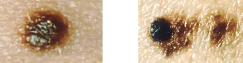 Two color photographs of a mole showing changes in the mole to development of a new mole
