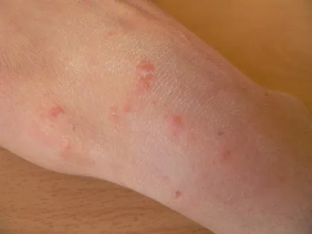 A color photograph of a right hand with read skin rashes.