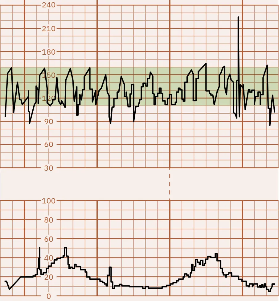 Fetal heart rate reading indicating marked variability.