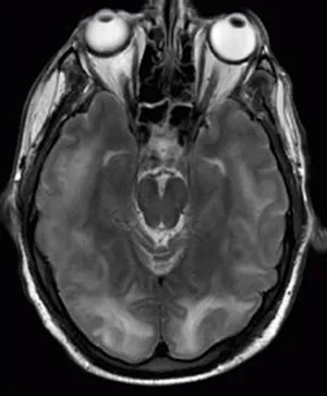 An MRI image of a brain is shown. This type of photography uses electromagnetic radiation to produce images.