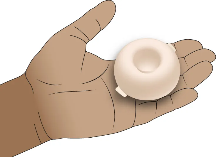 Image of a contraceptive sponge.