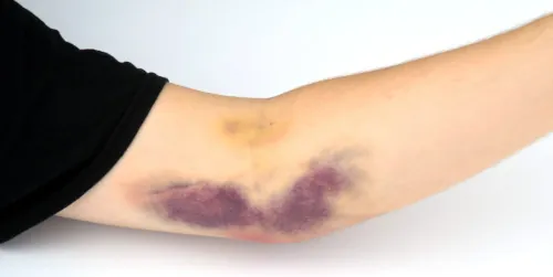 Example of a closed wound - a hematoma.