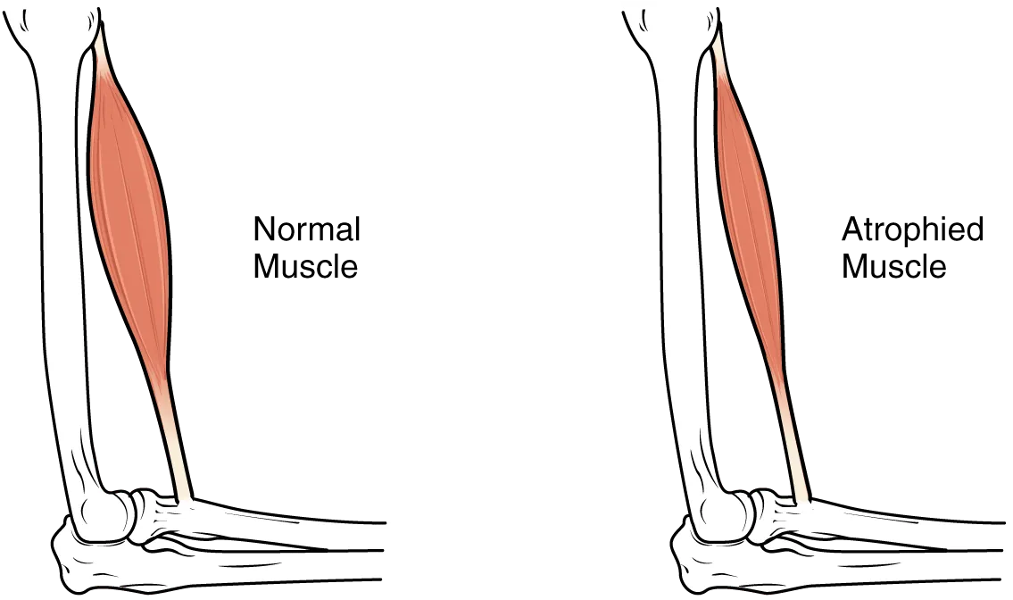 This image shows muscle atrophy. The left panel shows normal muscle and the right panel shows atrophied muscle.