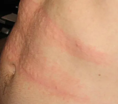 Urticaria