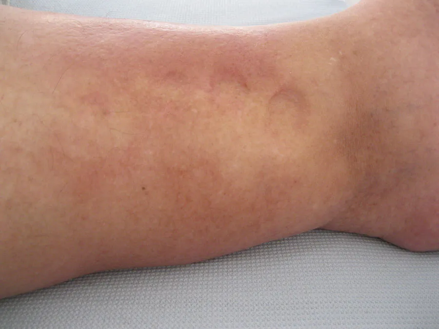 A photo of a leg with pitting edema.