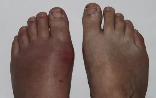 Photo shows a person's feet.  One foot is swollen and red, while the other appears normal.