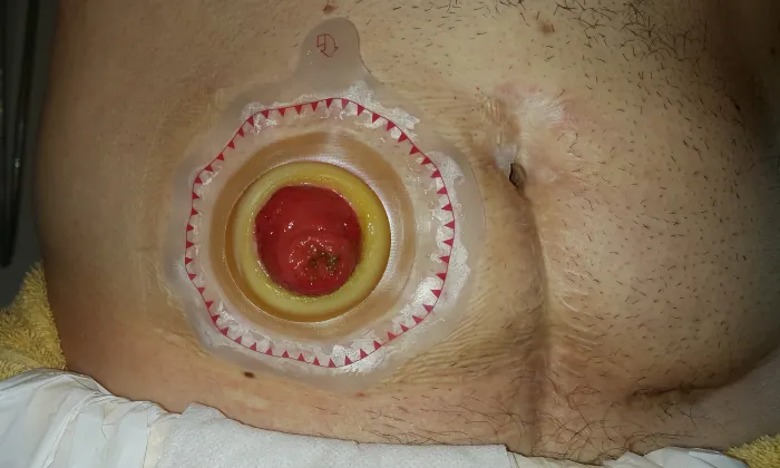 Photo of person wearing an ostomy wafer on their stomach.