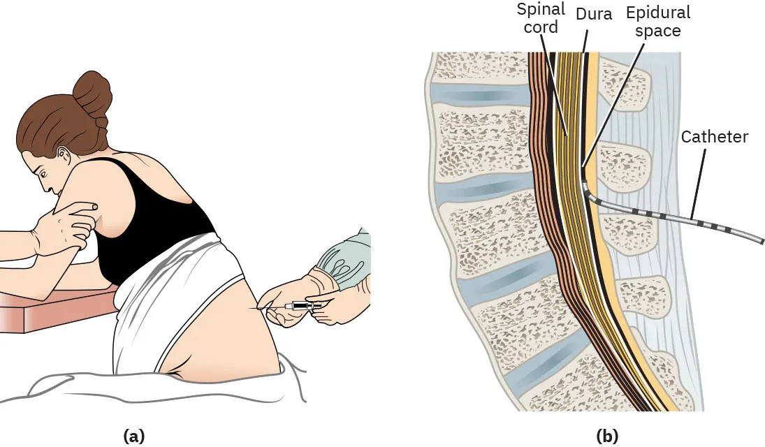 Diagram showing epidural catheter placement: (a) partner supporting laboring person sitting on edge of bed while epidural is placed, (b) epidural catheter placed between vertebrae into epidural space outside spinal cord.