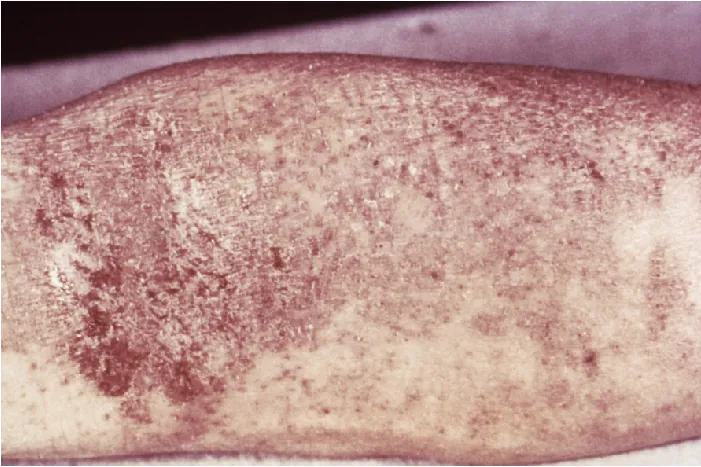 Photo of an Erythematous, crusty rash on the back of a knee.